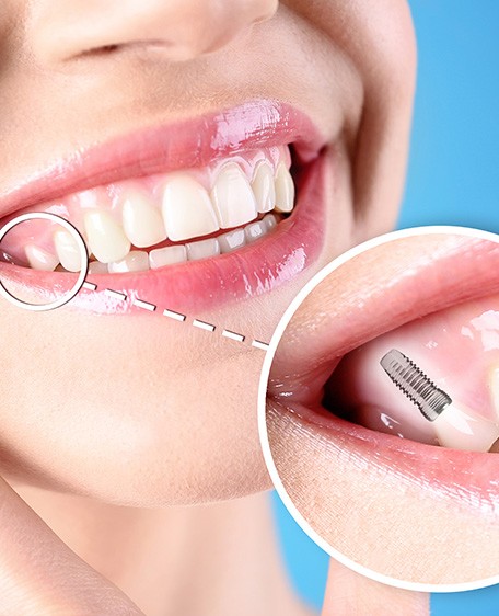 a patient with a dental implant smiling