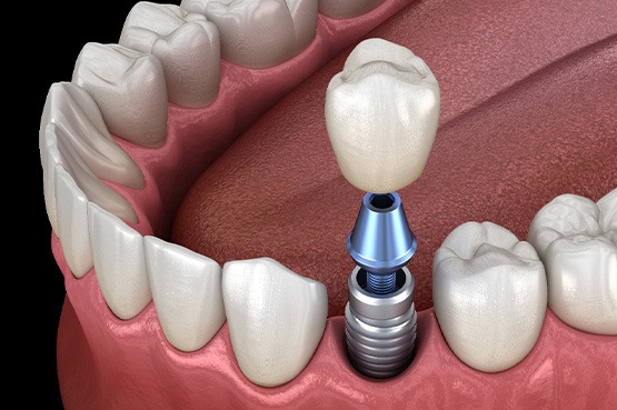 Illustration of a single dental implant