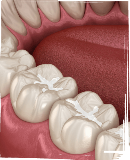 Illustrated row of teeth with dental sealants