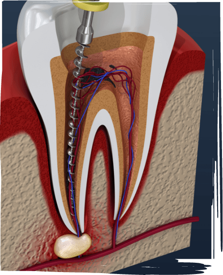 Illustrated dental instrument treating the inside of a tooth