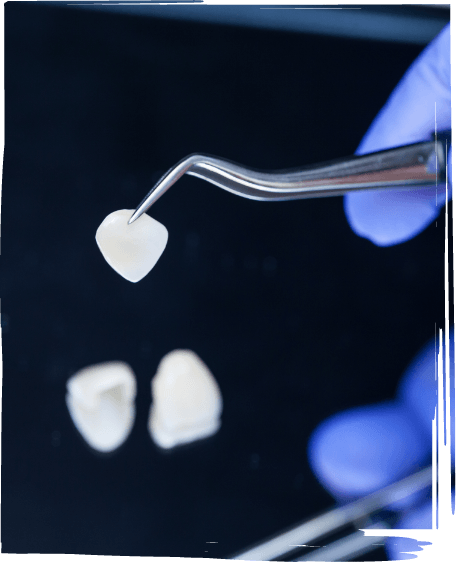 Dentist holding a veneer with tweezers