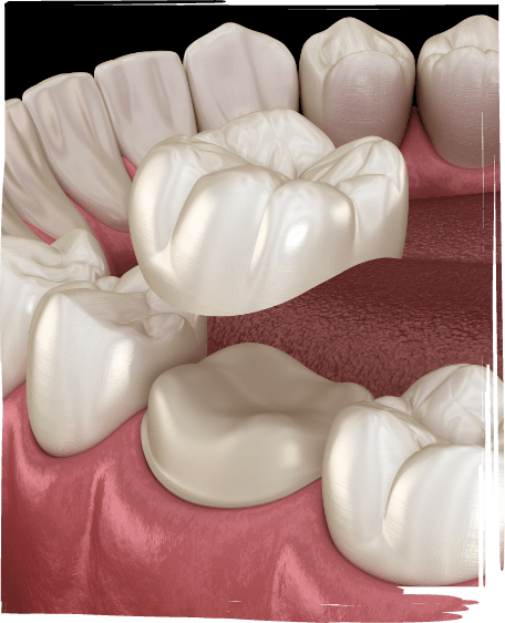 Illustrated dental crown being fitted over a tooth