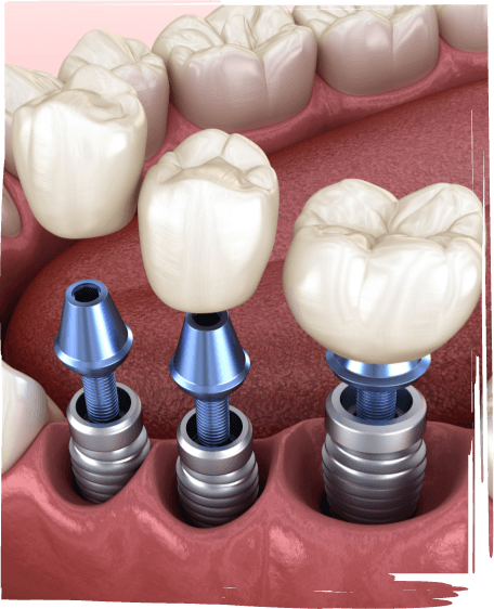 Three illustrated dental crowns being fitted onto three dental implants