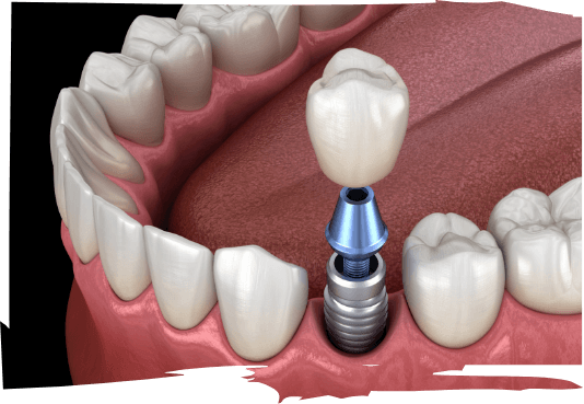 Illustrated dental crown being fitted onto a dental implant