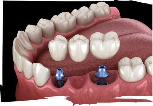 Illustrated dental bridge being fitted onto two dental implants