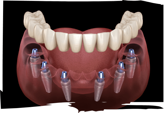 Illustrated full denture being fitted onto six dental implants
