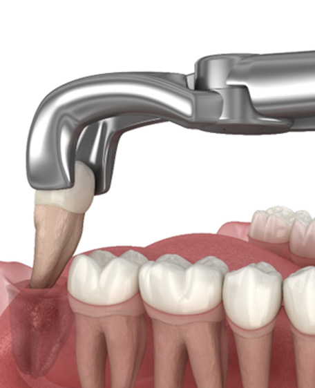 Illustration of a tooth being extracted