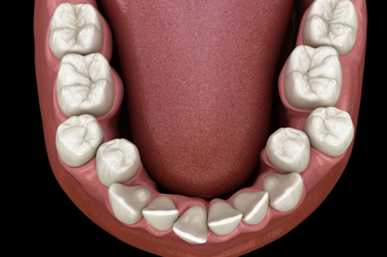 Illustration of crowded teeth