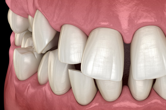 Illustration of gapped teeth