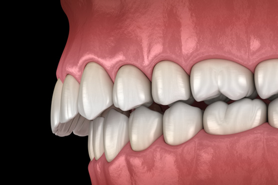 Illustration of an overbite
