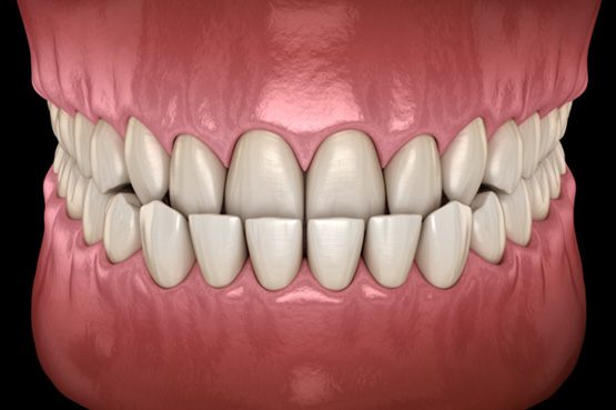 Illustration of an underbite