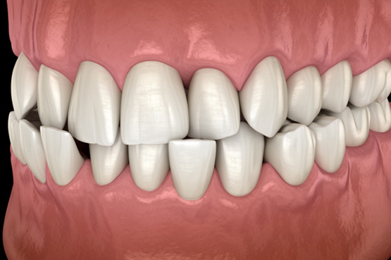 Illustration of a crossbite