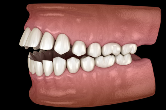 Illustration of an open bite