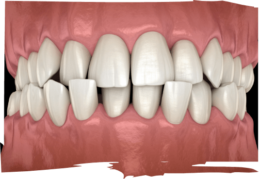 Illustrated mouth with crowded teeth