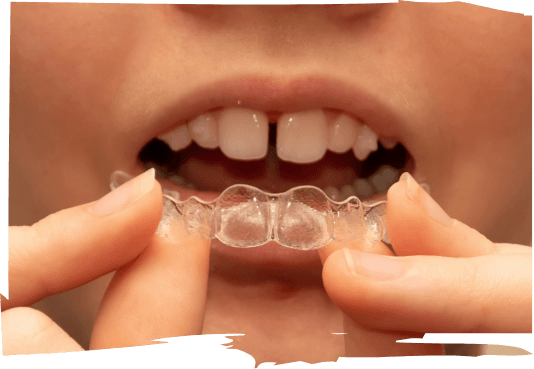 Person with gap between two front teeth holding Invisalign tray