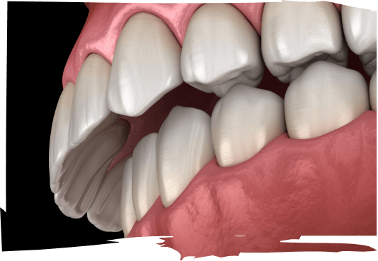 Illustrated mouth with overbite