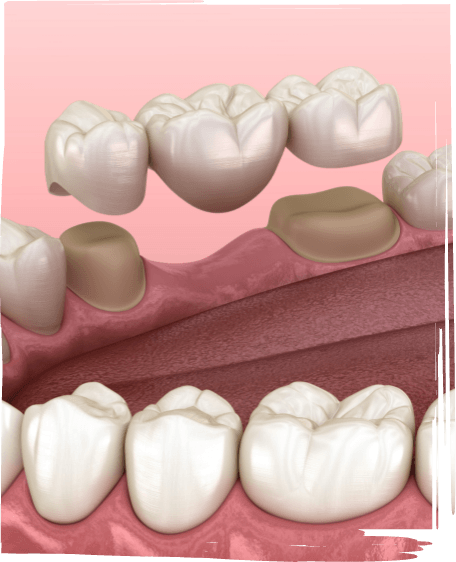 Illustrated dental bridge replacing a missing tooth