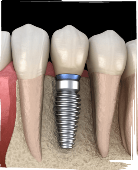 Illustrated dental implant replacing a missing lower tooth