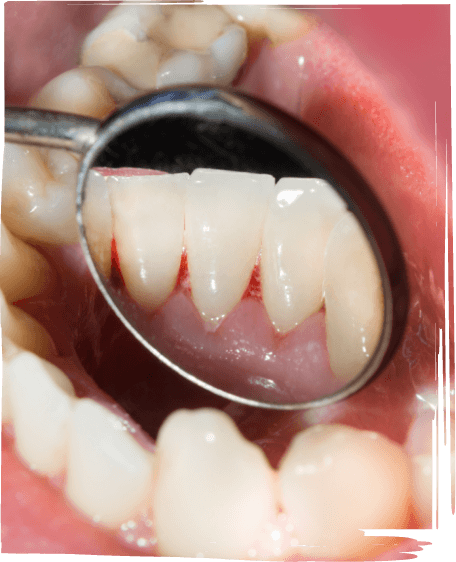 Close up of dental mirror inside of mouth