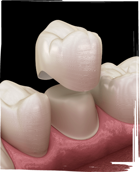 Illustrated dental crown being fitted over a tooth