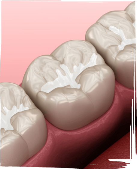 Illustrated row of teeth with white fillings