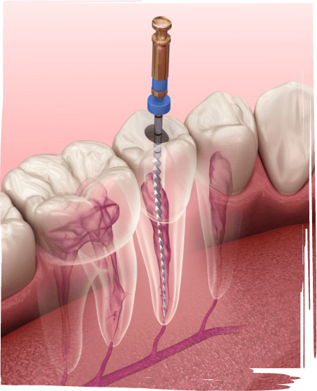 Illustrated dental instrument cleaning inside of tooth during root canal treatment