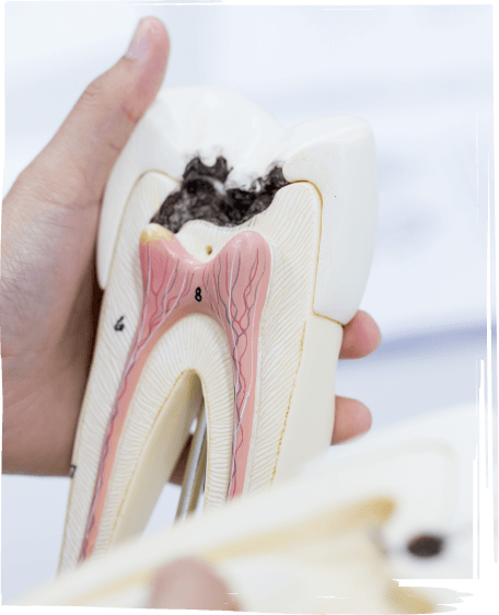 Hand holding a model of a decayed tooth