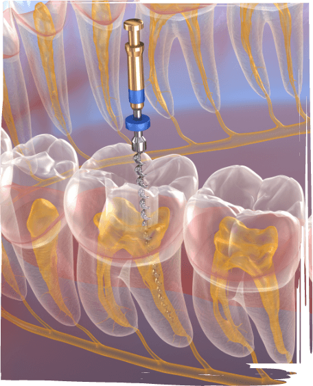 Illustrated dental instrument performing root canal treatment