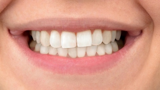 Close up of smile with whiter teeth