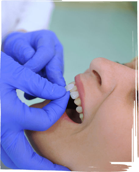Dentist placing a veneer over a tooth