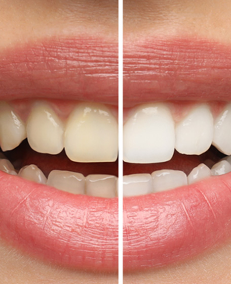 Closeup of patient's teeth before and after teeth whitening