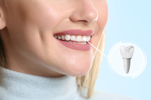 a model of dental implants 
